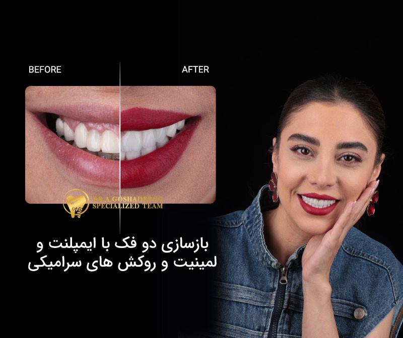 بازسازی دو فک با ایمپلنت و لمینیت و روکش